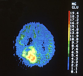 Brain Cancer PET scan